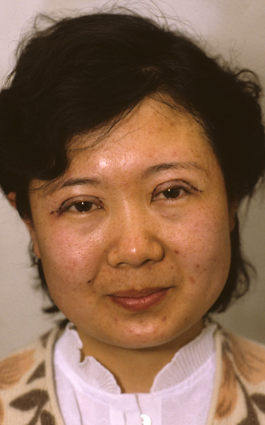 Woman who had eyelid surgery